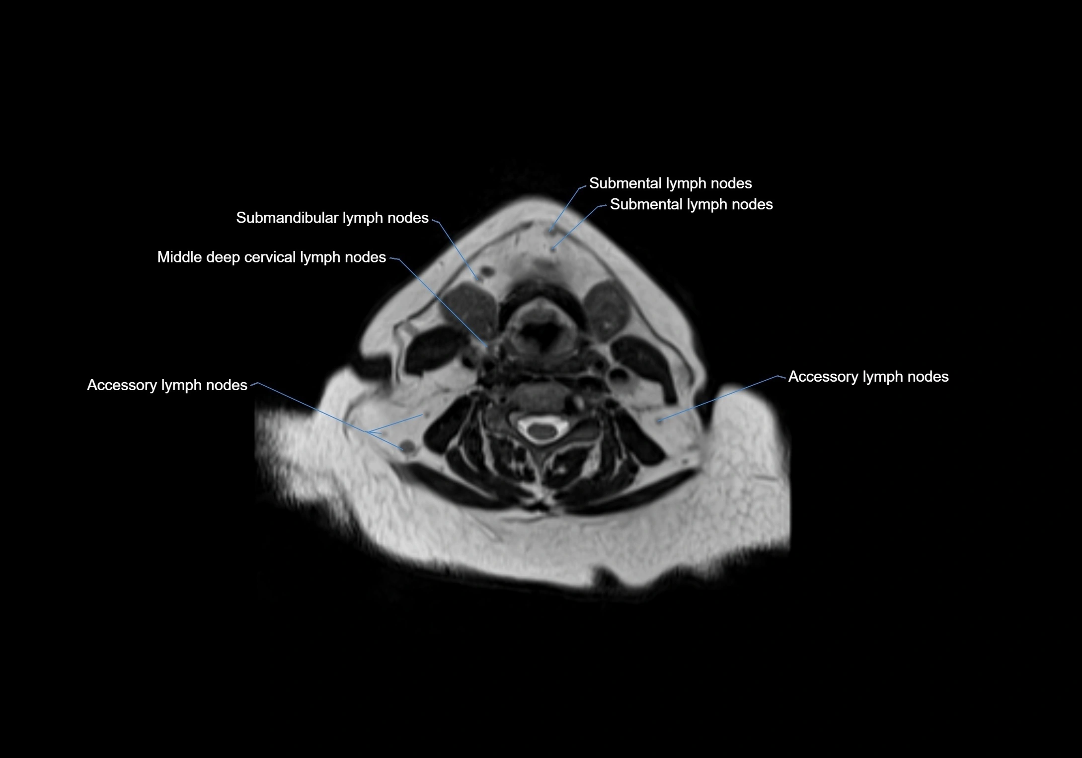 Neck axial  lymph node cross sectional MRI anatomy 3T MRI  image-img-00001-00059.webp